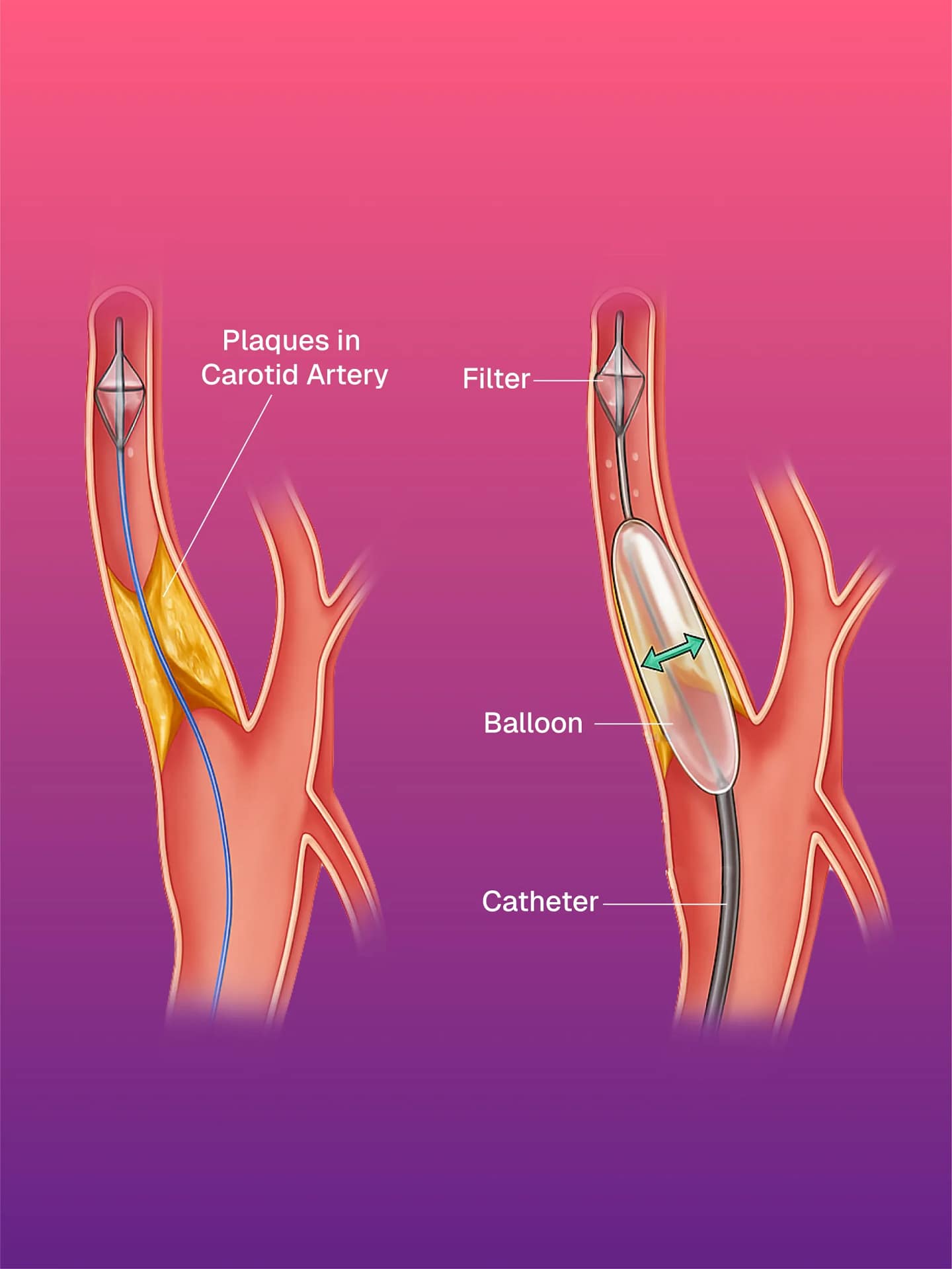Carotid & Vertebral Angioplasty / Stenting