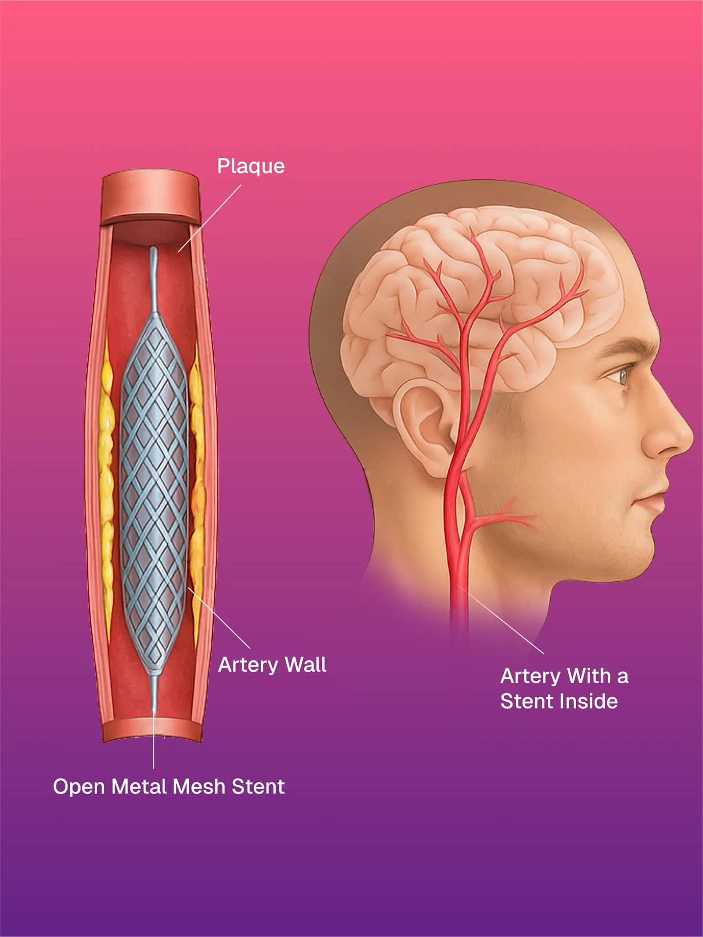 Intracranial Angioplasty & Stenting