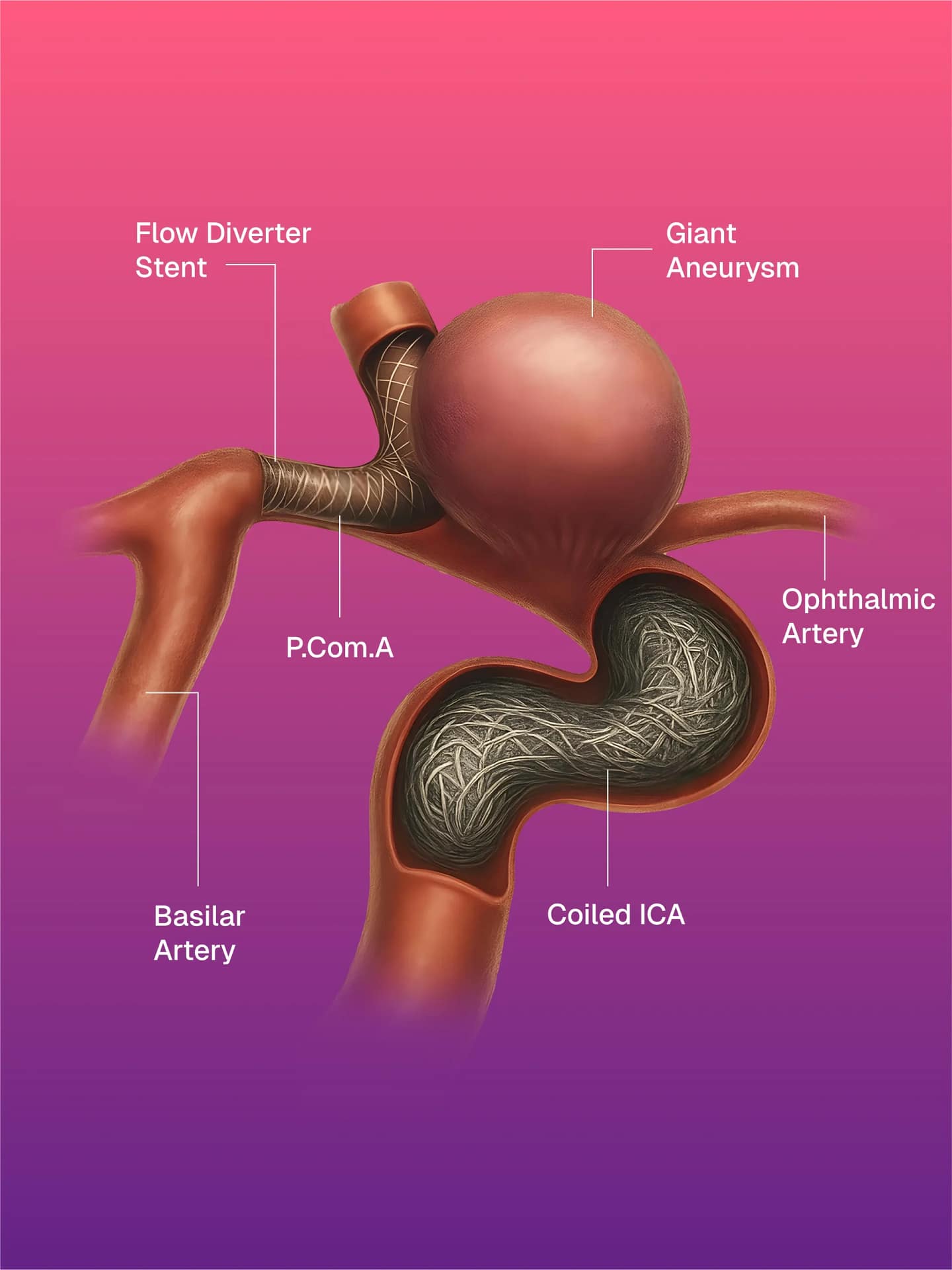 Brain Aneurysm-Coiling, Flow Diverter, Parent Vessel Occlusion