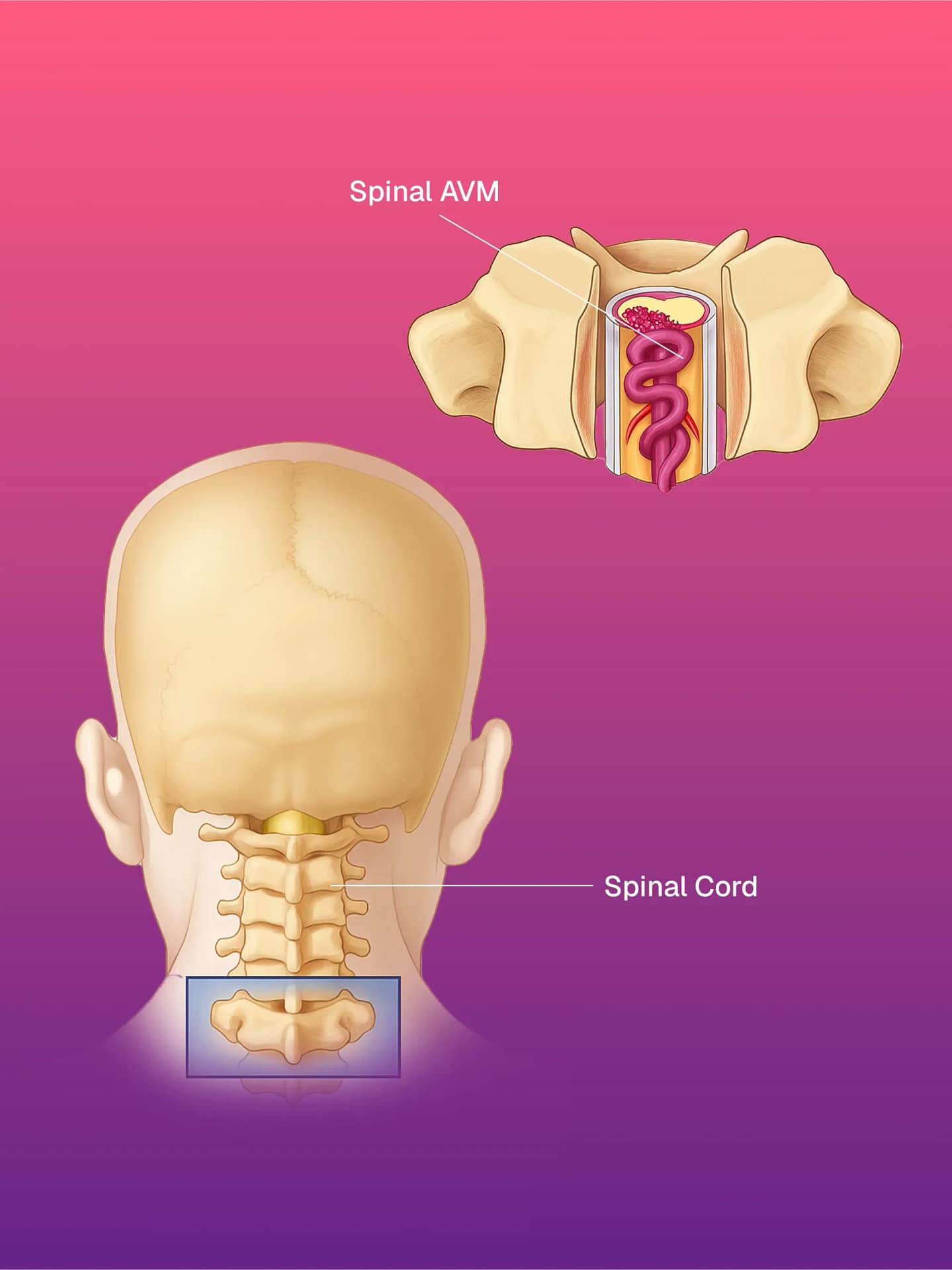 Brain & Spinal Cord AVM/AVF Embolization