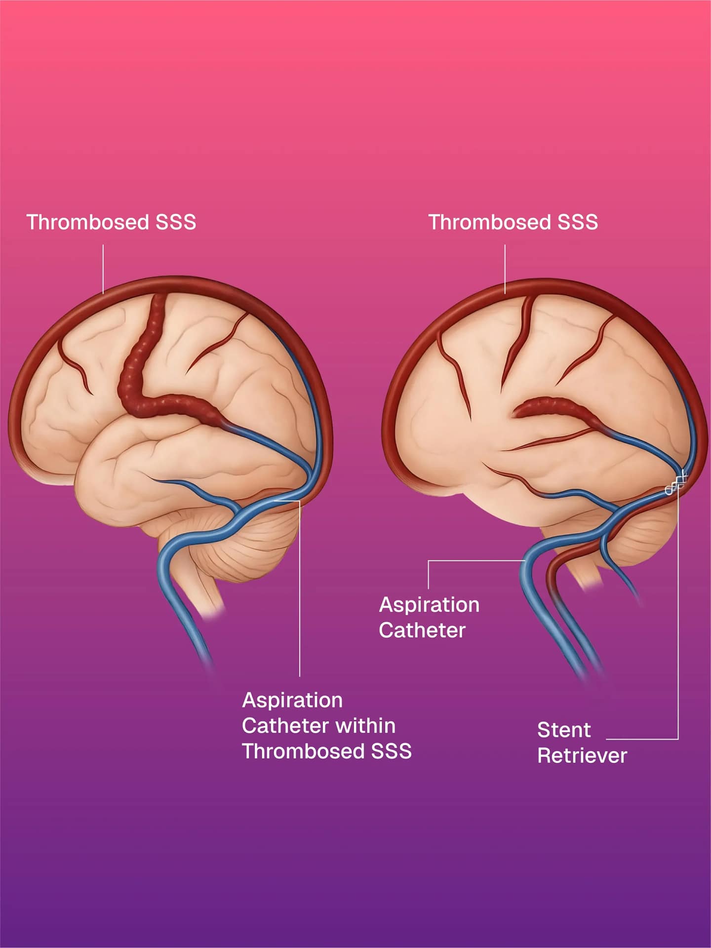 CDT & Thrombus Aspiration for Cerebral Venous Sinus Thrombosis