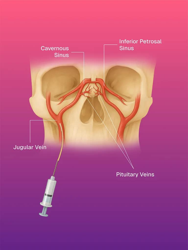 Inferior Petrosal Sinus Sampling