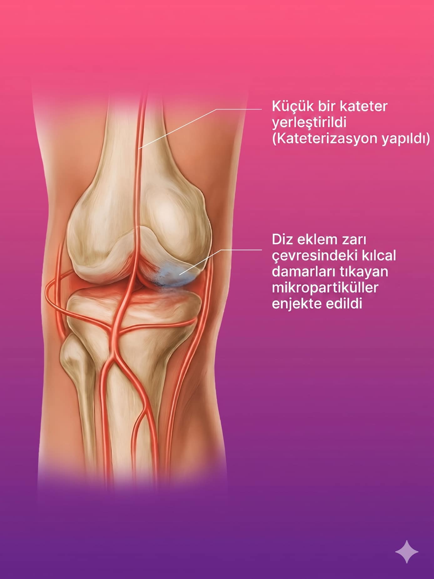 Diz Ağrısında Geniküler Arter Embolizasyon Tedavisi