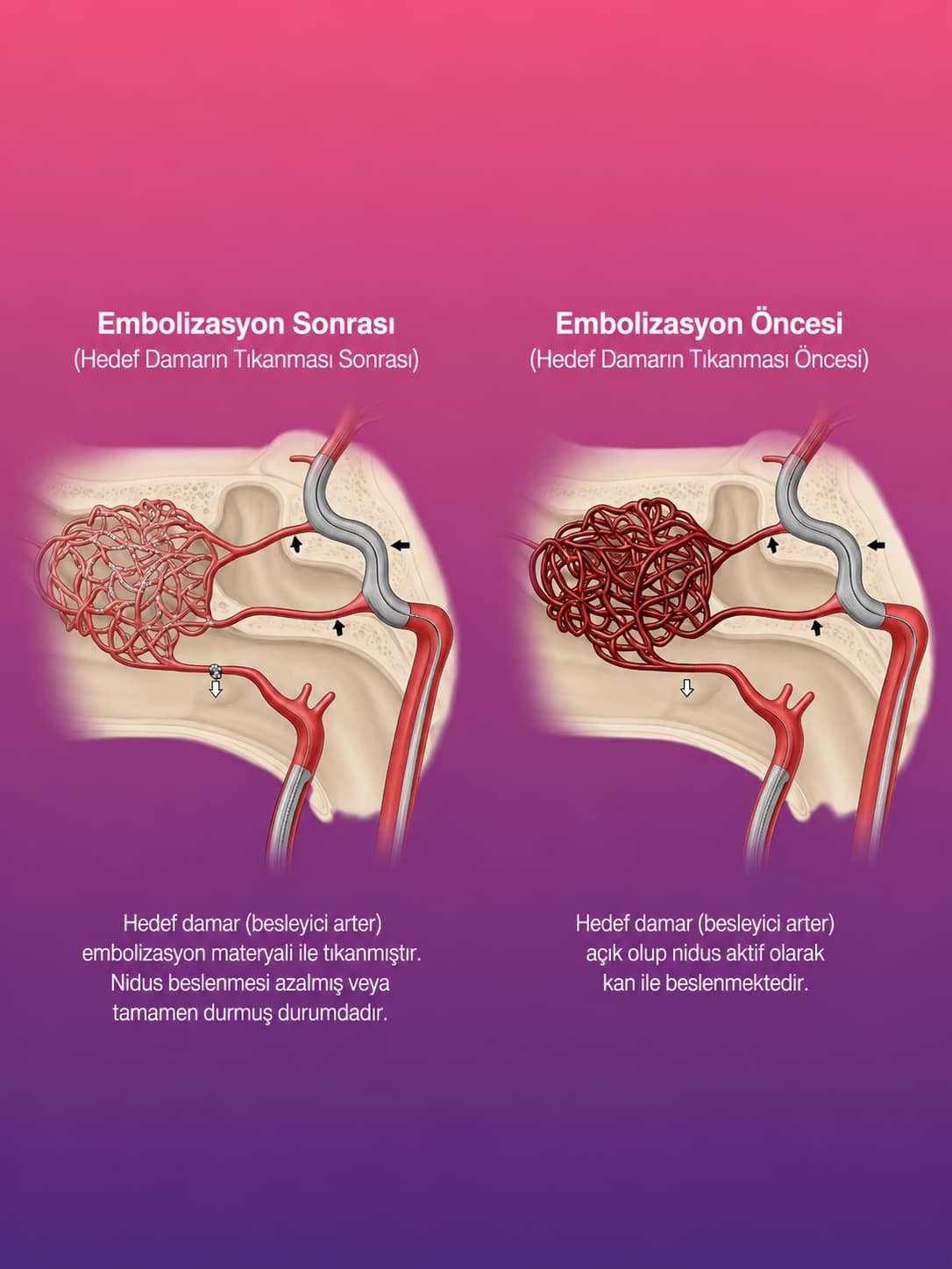 Venöz Malformasyonda Girişimsel İşlemler