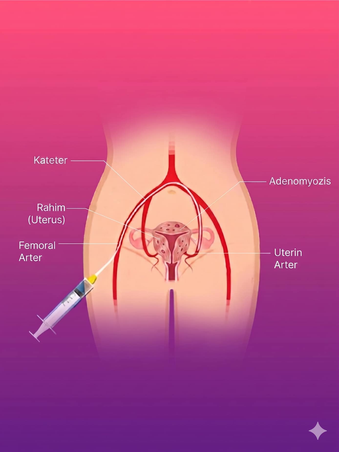 Adenomyozis Embolizasyon Tedavisi
