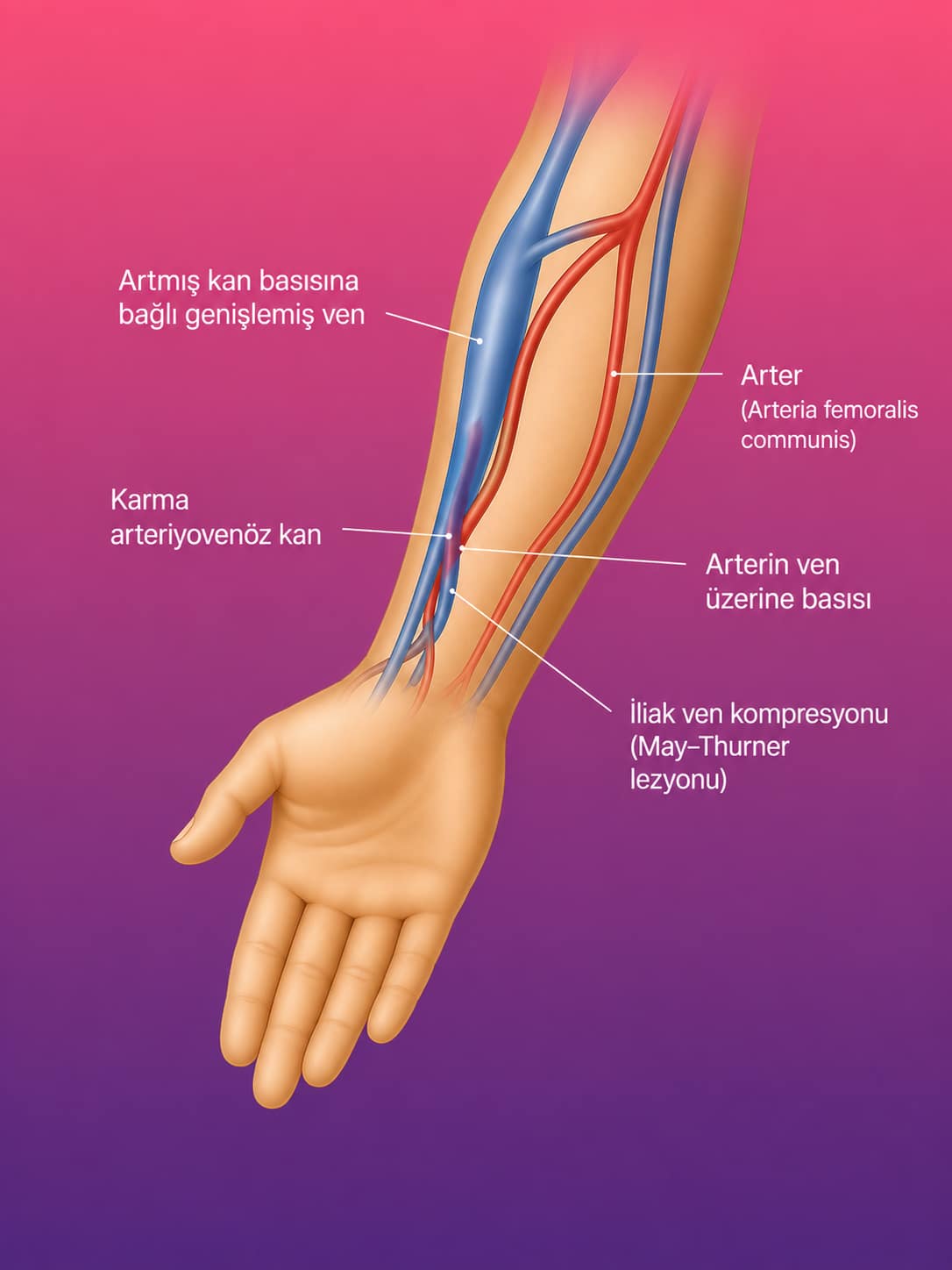 İntravasküler Yabancı Cisim Çıkarma
